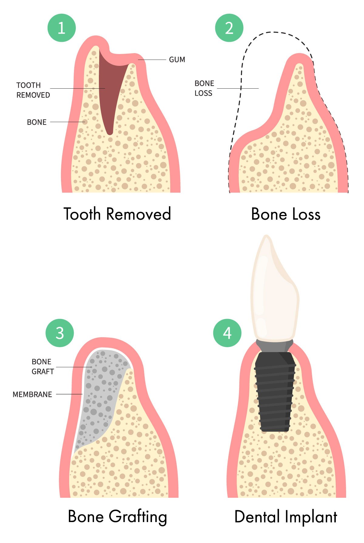 Bellingham and Snohomish Implant bone grafting