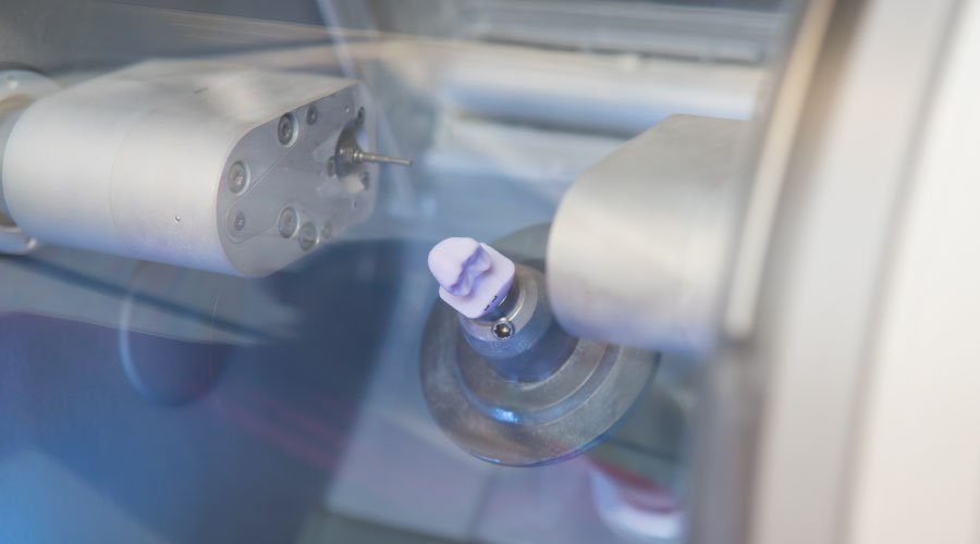 Bellingham and Snohomish CEREC Same-Day Crowns