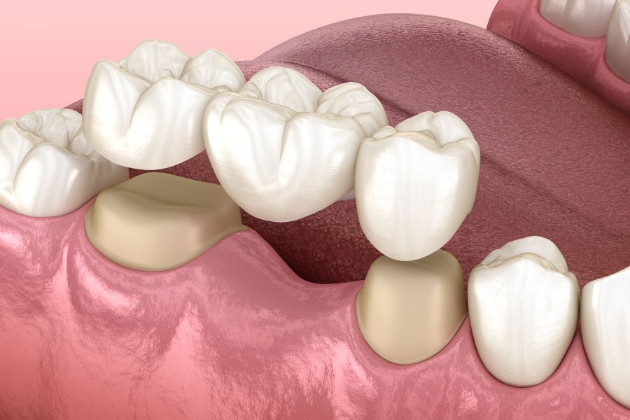 Bellingham Snohomish Dental Bridges