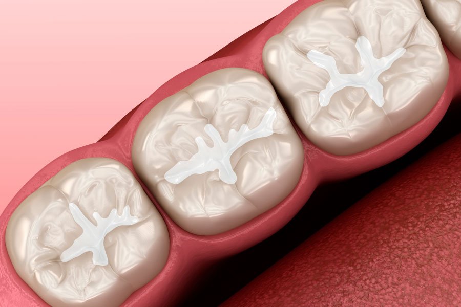 Bellingham Snohomish Dental Fillings