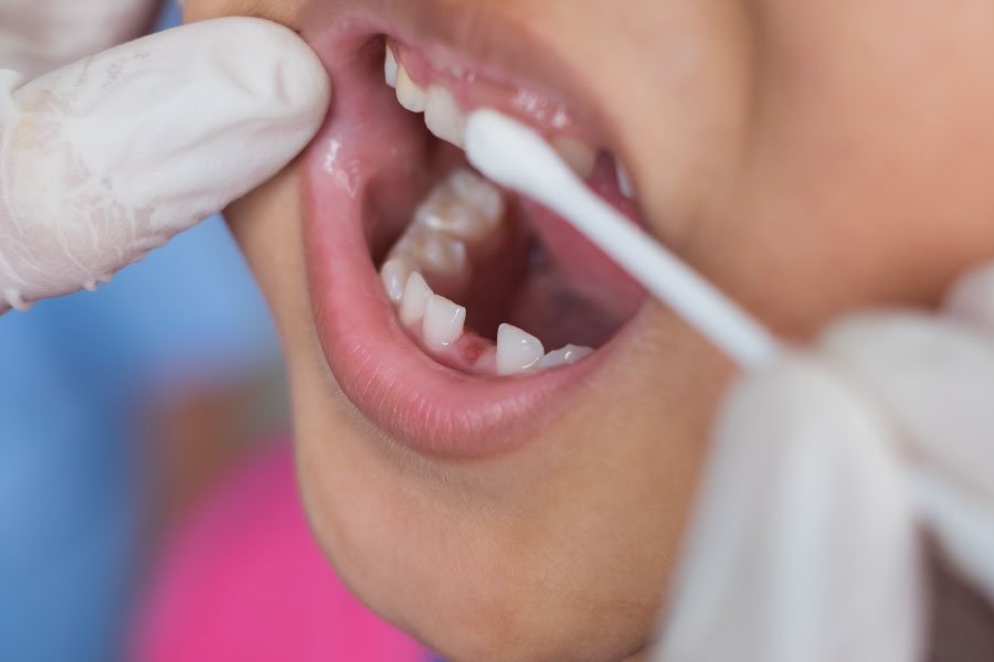 Bellingham Snohomish Fluoride Treatments