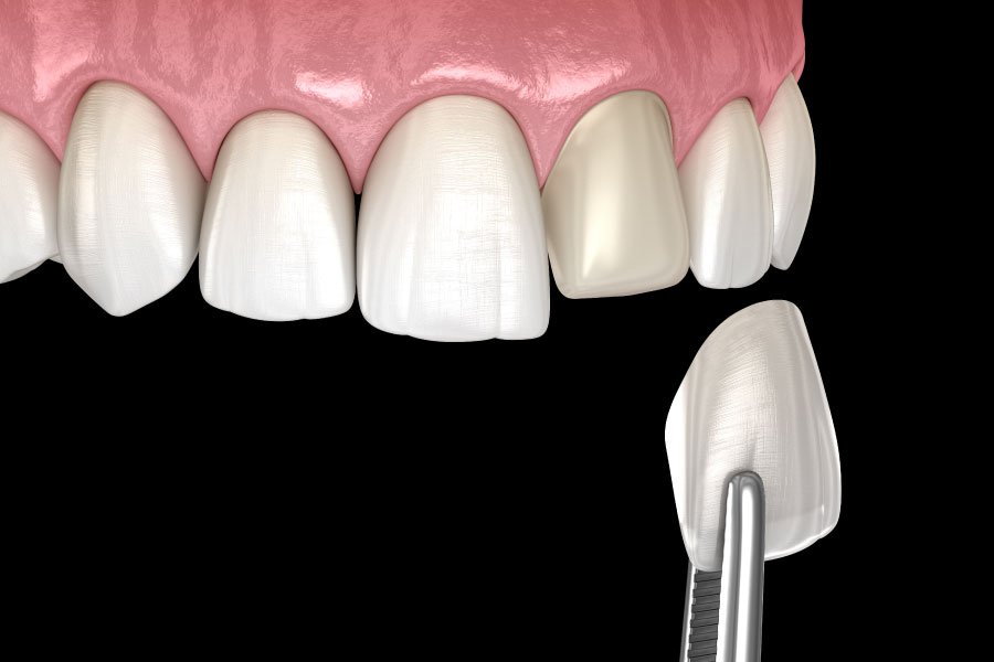 Bellingham Snohomish Porcelain Veneers