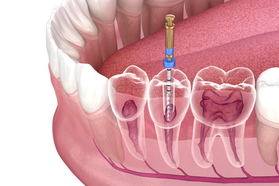 Bellingham and Snohomish Root Canals