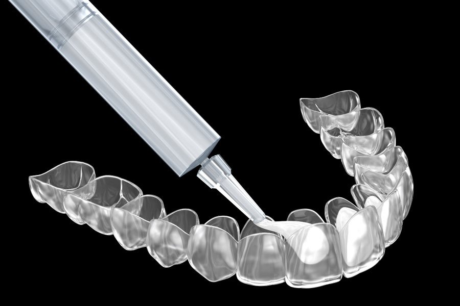 Bellingham Snohomish Teeth Whitening